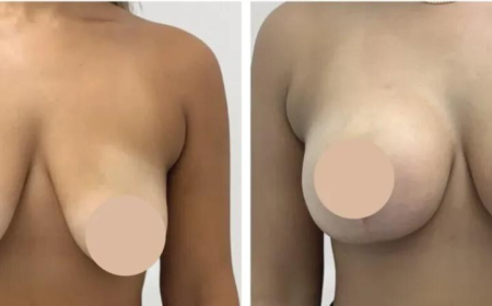 Breast Reduction in Dubai: Setting Realistic Expectations for Results
