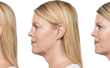 Benefits of Kybella Treatment for Double chin in Dubai