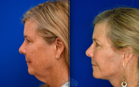 Neck Lift Surgery in Dubai: What to Expect