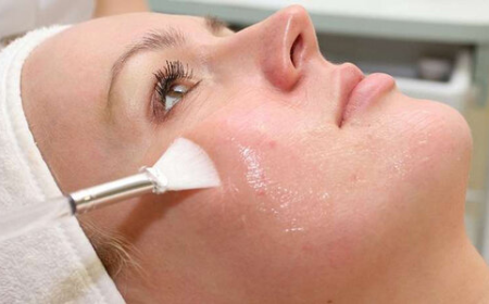Chemical Peels in Dubai for Acne-Prone Skin