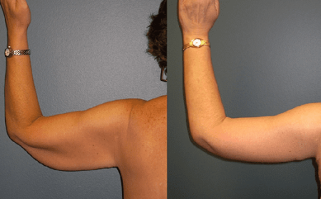 Arm Lift Surgery in Dubai for Toned Upper Arms