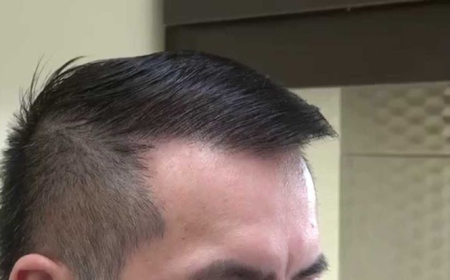 FUE Hair Transplant in Dubai: What to Expect