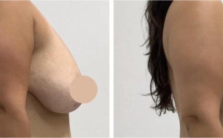 Breast Lift in Dubai for Refined Aesthetic Results