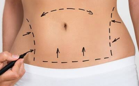 Liposuction Surgery in Dubai: Recovery Tips