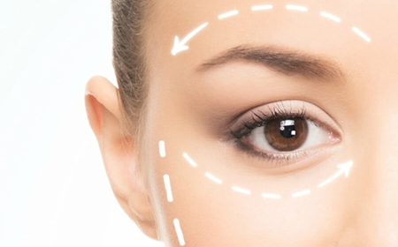 Brow Lift Surgery Dubai: Preparing for Your Procedure