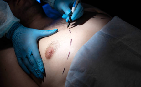 Gynaecomastia in Dubai and Causes of Male Breast Enlargement