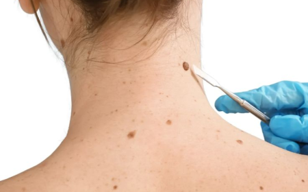 Mole Removal in Dubai: Signs You Should Not Ignore