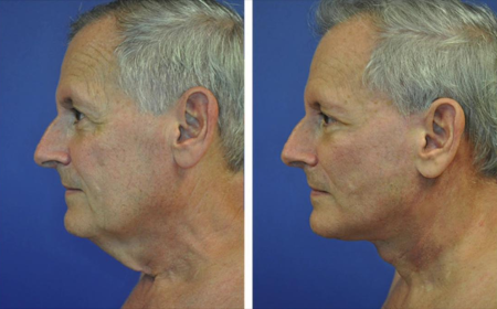 Benefits of Neck Lift Surgery in Dubai