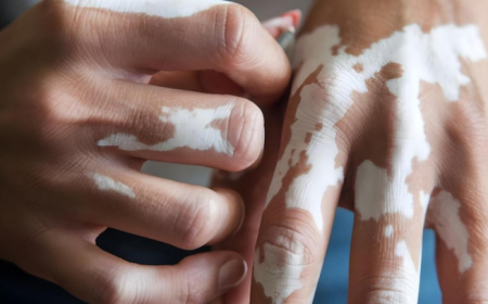 Vitiligo Treatment Planning: Exploring Individualised Homoeopathic Principles