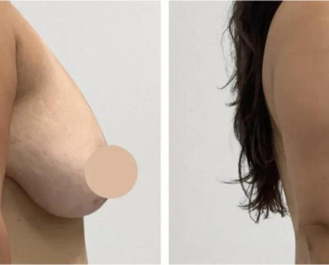 Breast Lift in Dubai for Refined Aesthetic Results