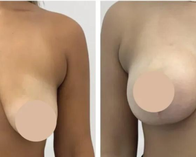 Breast Reduction in Dubai: Setting Realistic Expectations for Results